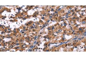 Immunohistochemistry of paraffin-embedded Human thyroid cancer tissue using R3HCC1L Polyclonal Antibody at dilution 1:40 (GIDRP88 抗体)