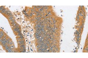 Immunohistochemistry of paraffin-embedded Human colon cancer tissue using ARHGAP5 Polyclonal Antibody at dilution 1:30 (ARHGAP5 抗体)