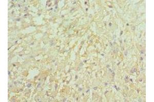 Immunohistochemistry of paraffin-embedded human glioma using ABIN7157975 at dilution of 1:100 (Leiomodin 1 抗体  (AA 29-187))