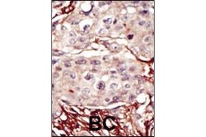 Formalin-fixed and paraffin-embedded human cancer tissue reacted with the primary antibody, which was peroxidase-conjugated to the secondary antibody, followed by DAB staining. (Aurora-B (ARK/STK12) (AA 283-313) 抗体)