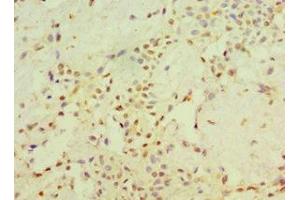 Immunohistochemistry of paraffin-embedded human breast cancer using ABIN7170704 at dilution of 1:100 (STARD3 抗体  (AA 170-445))