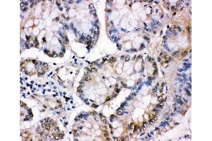 IHC-P: MCM5 antibody testing of human intestinal cancer tissue (MCM5 抗体  (C-Term))