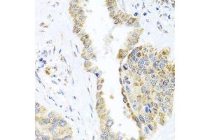 Immunohistochemistry of paraffin-embedded human lung cancer using DARS2 antibody. (DARS2 抗体  (AA 406-645))