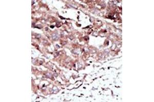 Formalin-fixed and paraffin-embedded human cancer tissue (hepatocarcinoma) reacted with the primary antibody, which was peroxidase-conjugated to the secondary antibody, followed by AEC staining. (PHKG2 抗体  (N-Term))