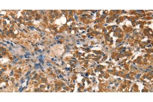Immunohistochemistry of paraffin-embedded Human thyroid cancer tissue using AGO1 Polyclonal Antibody at dilution 1:40 (AGO1 抗体)