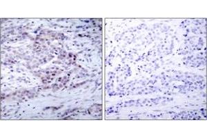 Immunohistochemistry analysis of paraffin-embedded human breast carcinoma, using NF-kappaB p100/p52 (Phospho-Ser869) Antibody. (NFKB2 抗体  (pSer870))