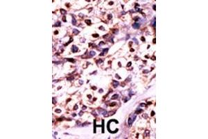 Formalin-fixed and paraffin-embedded human cancer tissue reacted with the primary antibody, which was peroxidase-conjugated to the secondary antibody, followed by DAB staining. (UCK2 抗体  (N-Term))