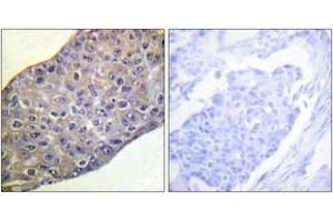 Immunohistochemistry analysis of paraffin-embedded human breast carcinoma tissue, using RhoA (Ab-188) Antibody. (RHOA 抗体  (AA 144-193))