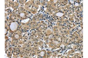 The image on the left is immunohistochemistry of paraffin-embedded Human thyroid cancer tissue using ABIN7131308(TBL1Y Antibody) at dilution 1/20, on the right is treated with fusion protein. (TBL1Y 抗体)