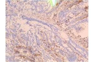 Staining of frozen tissue sections of colon carcinoma using SSEA-4 F8 antibody (Recombinant SSEA-4 抗体)