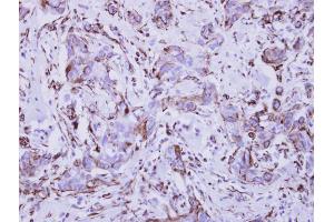 IHC-P Image Immunohistochemical analysis of paraffin-embedded human breast cancer, using Interferon gamma Receptor 1, antibody at 1:250 dilution. (IFNGR1 抗体)
