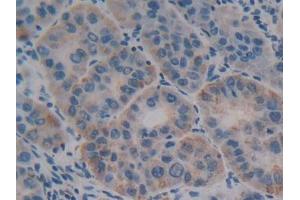 DAB staining on IHC-P; Samples: Human Liver cancer Tissue (Olfactomedin 4 抗体  (AA 407-510))