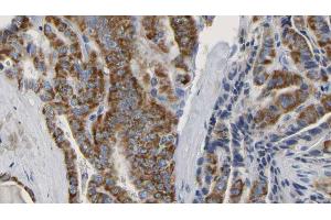 ABIN6267150 at 1/100 staining Human thyroid cancer tissue by IHC-P. (NCF4 抗体  (pThr154))