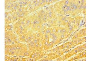 Immunohistochemistry of paraffin-embedded human liver cancer using ABIN7149270 at dilution of 1:100 (CYP4A11 抗体  (AA 1-200))
