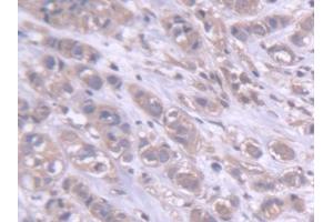 DAB staining on IHC-P; Samples: Human Breast cancer Tissue (DARS 抗体  (AA 363-501))