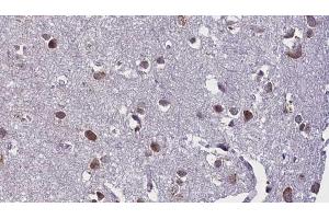 ABIN6268871 at 1/100 staining Human brain cancer tissue by IHC-P.
