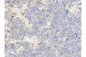 ABIN6256596 and ABIN6267259 at 1/100 staining human melanoma by IHC-P. (EGFR 抗体  (pThr669, pTyr693))
