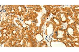 Immunohistochemistry of paraffin-embedded Human thyroid cancer using NAPA Polyclonal Antibody at dilution of 1:35 (NAPA 抗体)