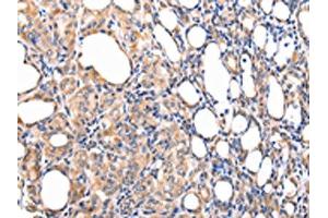 The image on the left is immunohistochemistry of paraffin-embedded Human thyroid cancer tissue using ABIN7190092(CCL7 Antibody) at dilution 1/20, on the right is treated with synthetic peptide. (CCL7 抗体)