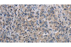 Immunohistochemistry of paraffin-embedded Human liver cancer using MCM3AP Polyclonal Antibody at dilution of 1:30 (GANP 抗体)
