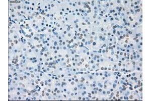 Immunohistochemical staining of paraffin-embedded Adenocarcinoma of colon tissue using anti-SORDmouse monoclonal antibody. (SORD 抗体)