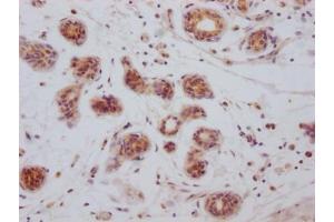 IHC image of ABIN7127365 diluted at 1:100 and staining in paraffin-embedded human breast cancer performed on a Leica BondTM system. (Recombinant BCL2L1 抗体)