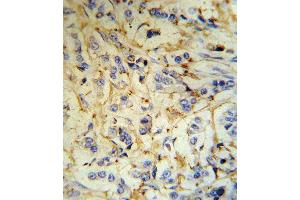 FGA Antibody (N-term) (R) IHC analysis in formalin fixed and paraffin embedded human breast carcinoma tissue followed by peroxidase conjugation of the secondary antibody and DAB staining. (FGA 抗体  (N-Term))