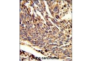 Formalin-fixed and paraffin-embedded human lung carcinoma reacted with ARPC1B Antibody (Center), which was peroxidase-conjugated to the secondary antibody, followed by DAB staining. (ARPC1B 抗体  (AA 159-188))