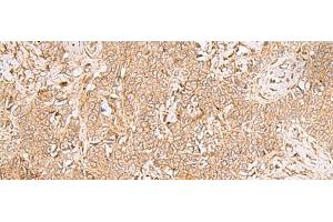 Immunohistochemistry of paraffin-embedded Human ovarian cancer tissue using GMPPB Polyclonal Antibody at dilution of 1:50(x200)