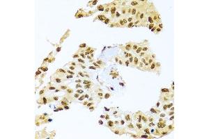 Immunohistochemistry of paraffin-embedded human lung cancer using SMEK1 antibody. (SMEK1 抗体  (AA 395-594))