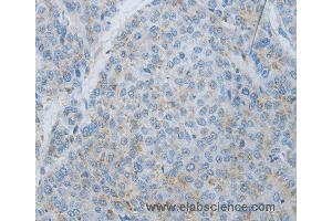 Immunohistochemistry of Human liver cancer using MMP25 Polyclonal Antibody at dilution of 1:80 (MMP25 抗体)