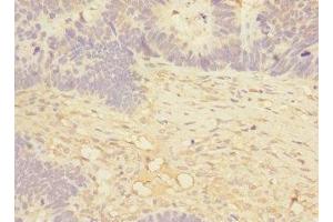Immunohistochemistry of paraffin-embedded human ovarian cancer using ABIN7160074 at dilution of 1:100 (MAP4K5 抗体  (AA 300-480))