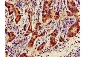 Immunohistochemistry of paraffin-embedded human pancreatic cancer using ABIN7160874 at dilution of 1:100 (NQO1 抗体  (AA 55-155))