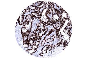 Endometroid carcinoma of the ovary depicting a strong PR immunostaining of all tumor cells (Recombinant Progesterone Receptor 抗体  (AA 1-200))