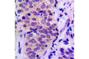 Immunohistochemical analysis of BAD (pS155) staining in human prostate cancer formalin fixed paraffin embedded tissue section. (BAD 抗体  (C-Term, pSer155))