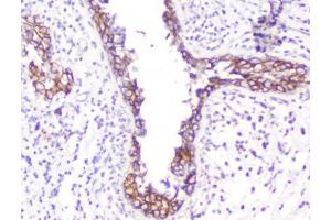 IHC testing of FFPE human breast cancer with Beta Catenin antibody. (beta Catenin 抗体  (AA 2-233))