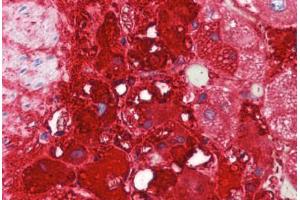 Human Adrenal (formalin-fixed, paraffin-embedded) stained with TH antibody ABIN462131 followed by biotinylated goat anti-rabbit IgG secondary antibody ABIN481713, alkaline phosphatase-streptavidin and chromogen. (Tyrosine Hydroxylase 抗体)