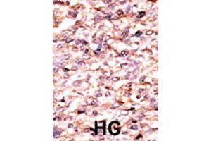 Formalin-fixed and paraffin-embedded human hepatocellular carcinoma tissue reacted with ACVR1C polyclonal antibody  , which was peroxidase-conjugated to the secondary antibody, followed by AEC staining. (ACVR1C/ALK7 抗体  (N-Term))