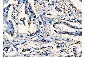 ABIN6265096 and ABIN6277789 at 1/100 staining Human colorectal cancer by IHC-P. (SIX2 抗体  (Internal Region))