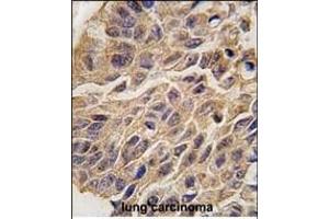 Formalin-fixed and paraffin-embedded human lung carcinoma tissue reacted with INDO antibody (C-term) (ABIN389194 and ABIN2839357) , which was peroxidase-conjugated to the secondary antibody, followed by DAB staining. (IDO1 抗体  (C-Term))
