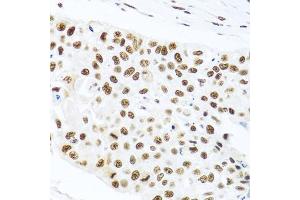 Immunohistochemistry of paraffin-embedded human lung cancer using PRPF19 antibody. (PRP19 抗体)