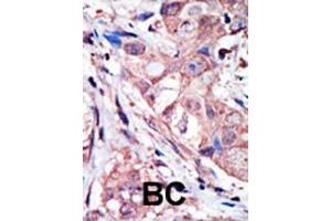 Formalin-fixed and paraffin-embedded human cancer tissue reacted with the primary antibody, which was peroxidase-conjugated to the secondary antibody, followed by AEC staining. (MAPK10 抗体  (N-Term))