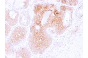 Formalin-fixed, paraffin-embedded human Prostate Carcinoma stained with CD44v6 Mouse Monoclonal Antibody (CD44V6/2496). (CD44 抗体)