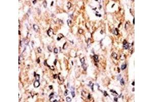 IHC analysis of FFPE human hepatocarcinoma tissue stained with the GCN2 antibody (GCN2 抗体  (AA 1-30))