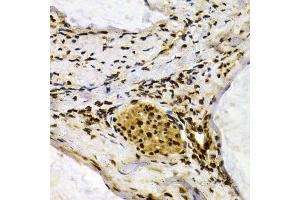 Immunohistochemistry of paraffin-embedded human colon carcinoma using IFIH1 antibody (ABIN5971229) at dilution of 1/200 (40x lens). (IFIH1 抗体)