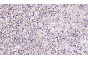 ABIN6273088 at 1/100 staining Human lymph cancer tissue by IHC-P. (ACADVL 抗体  (Internal Region))