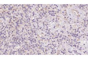 ABIN6273088 at 1/100 staining Human lymph cancer tissue by IHC-P.