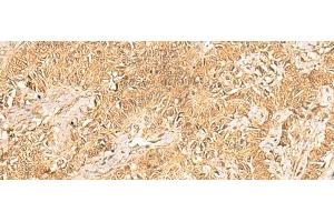 Immunohistochemistry of paraffin-embedded Human ovarian cancer tissue using TRMT112 Polyclonal Antibody at dilution of 1:30(x200) (TRMT112 抗体)