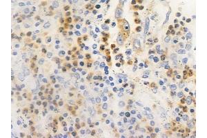 ABIN6261154 and ABIN6266525 at 1/100 staining human colon carcinoma by IHC-P. (Cyclin G1 抗体  (Internal Region))