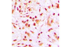 Immunohistochemical analysis of Histone H4 (AcK8) staining in human lung cancer formalin fixed paraffin embedded tissue section.